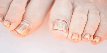 Nail Fungus: Understanding Causes And Exploring Effective Treatments - elonessentials.com