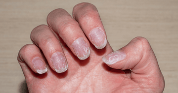 Common Causes Of Brittle Nails And How To Address Them - elonessentials.com