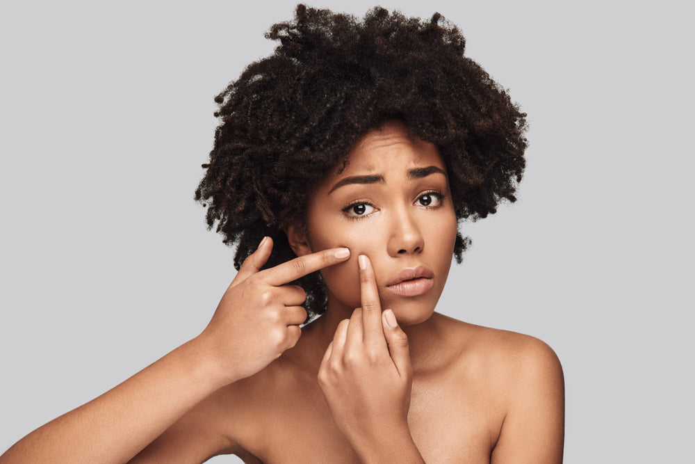 5 of the Most Common Acne Myths Busted